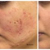 Image 6: One or Three Sessions of Microneedling with/without LED Light Therapy