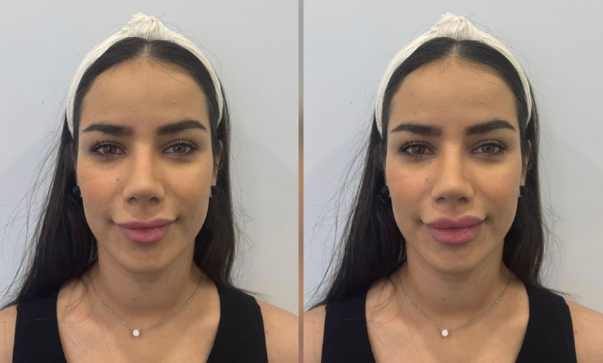 Image 5: Revitalize with 0.5 or 1 ml of Revolax Dermal Filler with Consultation