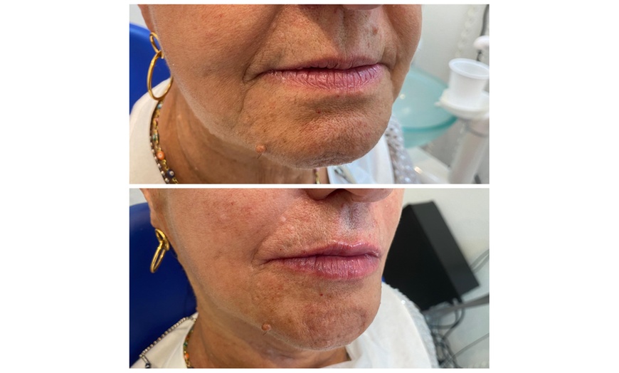 Image 6: ¡Infiltración de relleno dérmico con opción a blanqueamiento dental!