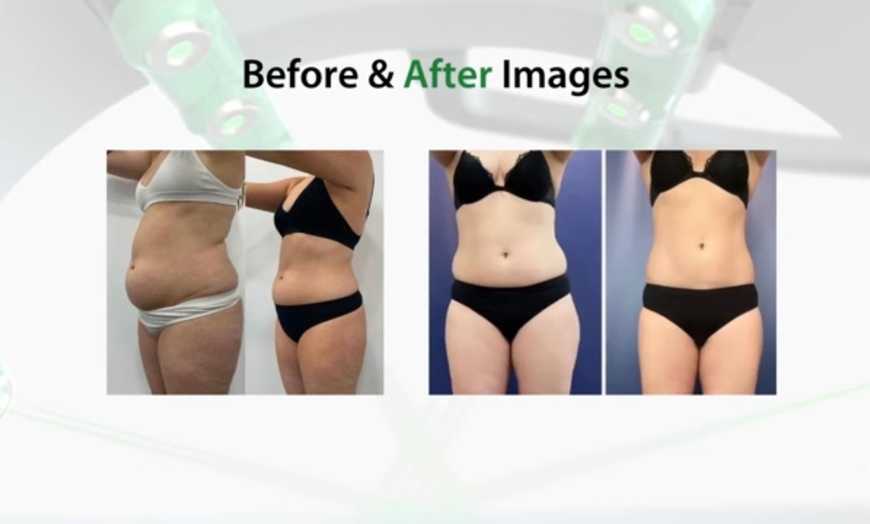 Image 3: Emerald Laser Fat Loss - Up To 4 inches Loss