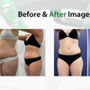 Image 3: Emerald Laser Fat Loss - Up To 4 inches Loss