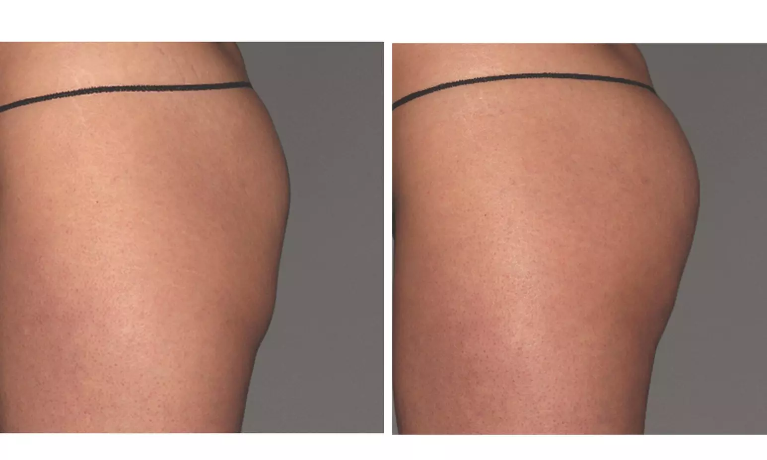 One or Two Cool Tone Sessions for Body Toning
