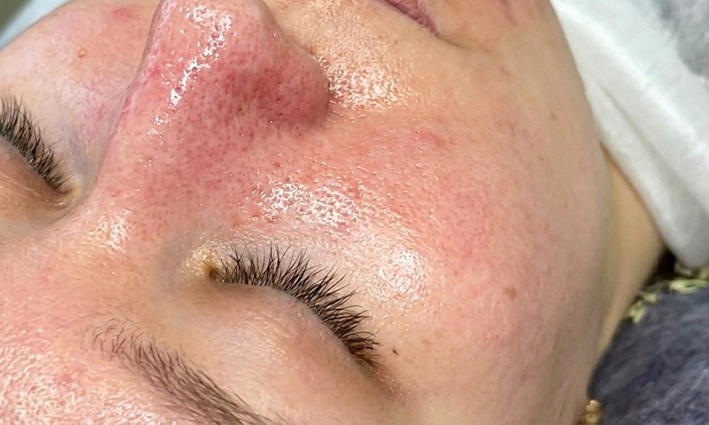 Microneedling-Behandlung mit Wirkstoffampulle für 1 Person