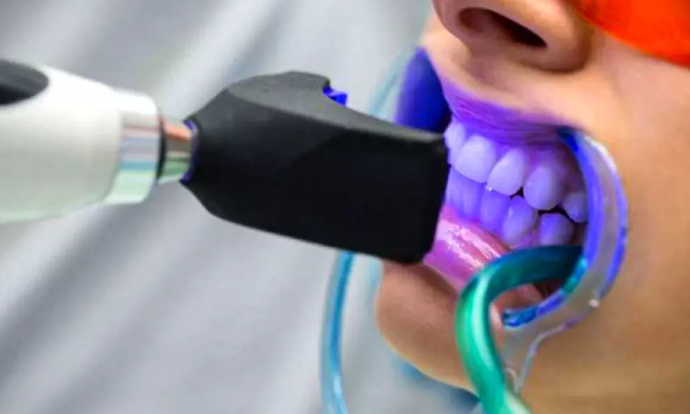 Blanchiment dentaire avec Atelier Beauty