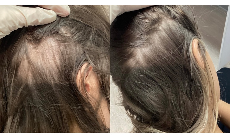 Image 4: One, Two, or Three Sessions of  PRP Hair Growth Treatment 