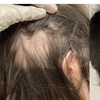 Image 4: One, Two, or Three Sessions of  PRP Hair Growth Treatment 