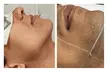 A-ONE Laser Clinic: Three Laser Hair Removal Sessions for Small, Medium or Large Area (Up To 75% Off) - Second Medium