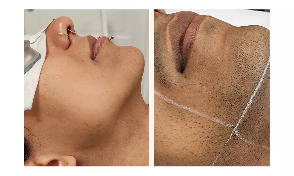 3 Laser Hair Removal Sessions for Small, Medium or Large Area