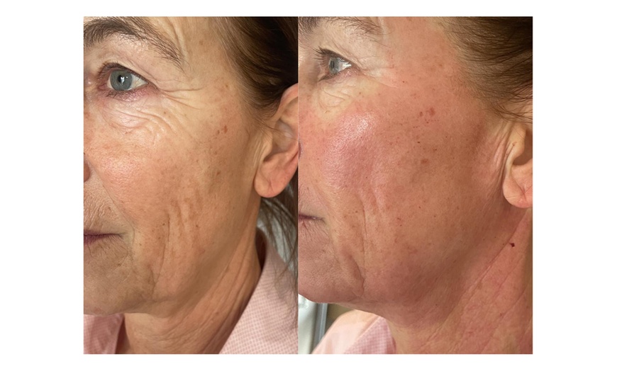 Image 3: Bis zu 70% Rabatt auf Micro-Needling bei Aestheticum skin