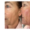 Image 3: Bis zu 70% Rabatt auf Micro-Needling bei Aestheticum skin