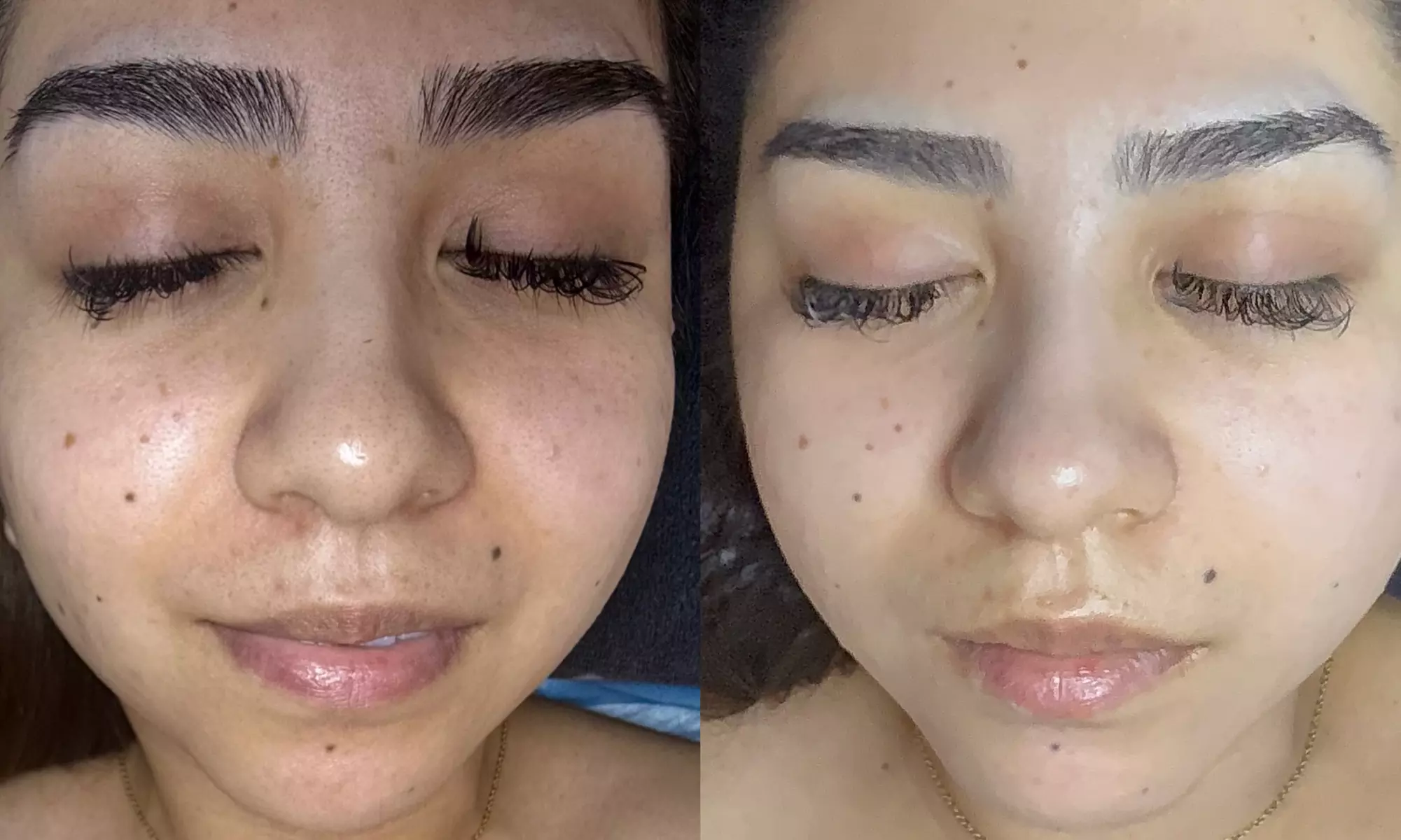 Facelift, Body Contouring & Lymphatic Massage for Total Renewal