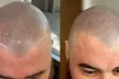 Get Scalp Micropigmentation Hair Loss or Balding / Small Bald or Thinning Area Treatment - Up to 50% Off - Second Medium