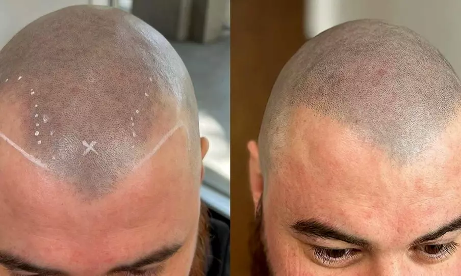 Scalp Micropigmentation Hair Loss, Balding, or Thinning Treatment