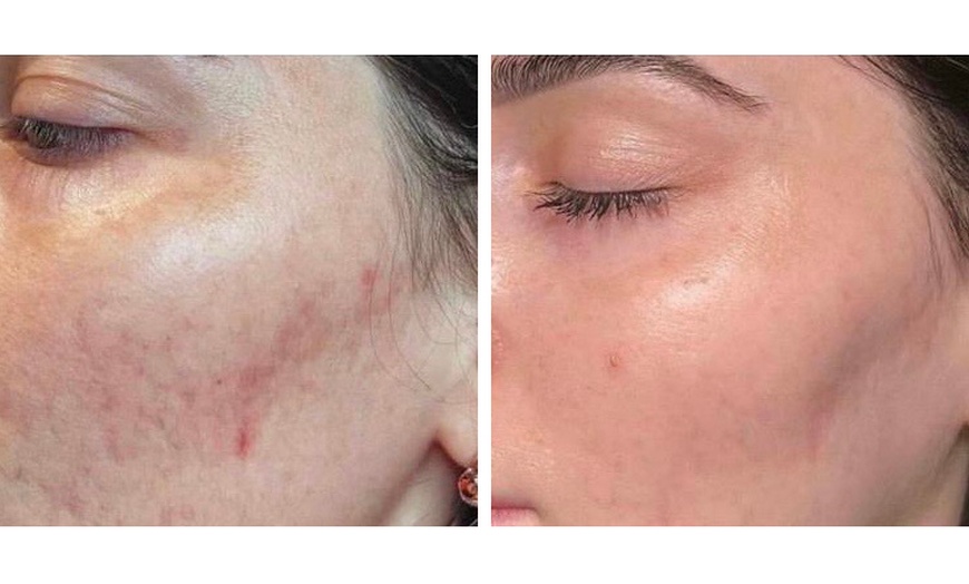 Image 2: Up to 40% Off on Micro-Needling at Bourne Beauty Laser Tattoo Removal