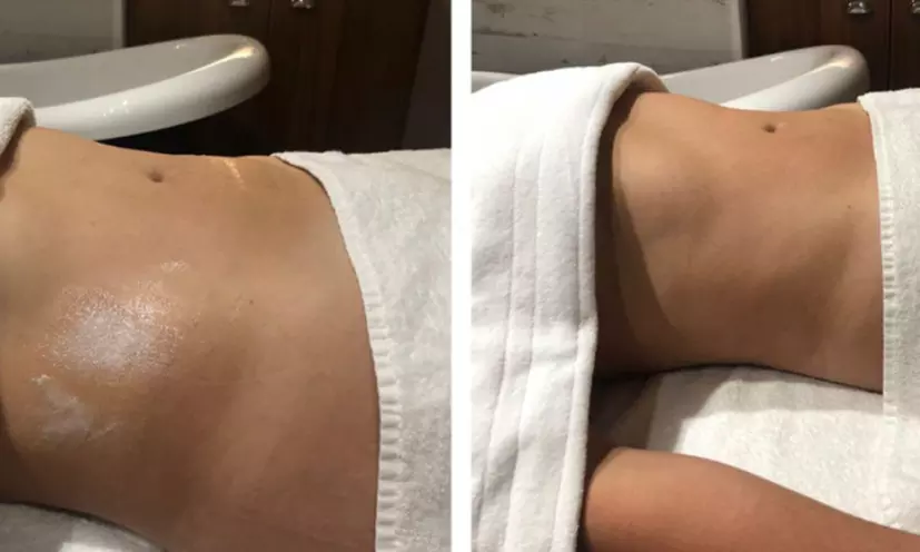 Body Contouring Packages to Tone, Slim & Sculpt 