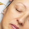 Image 1: DOT Plasma For Wrinkles: Crows Feet, Forehead, Around the Mouth!