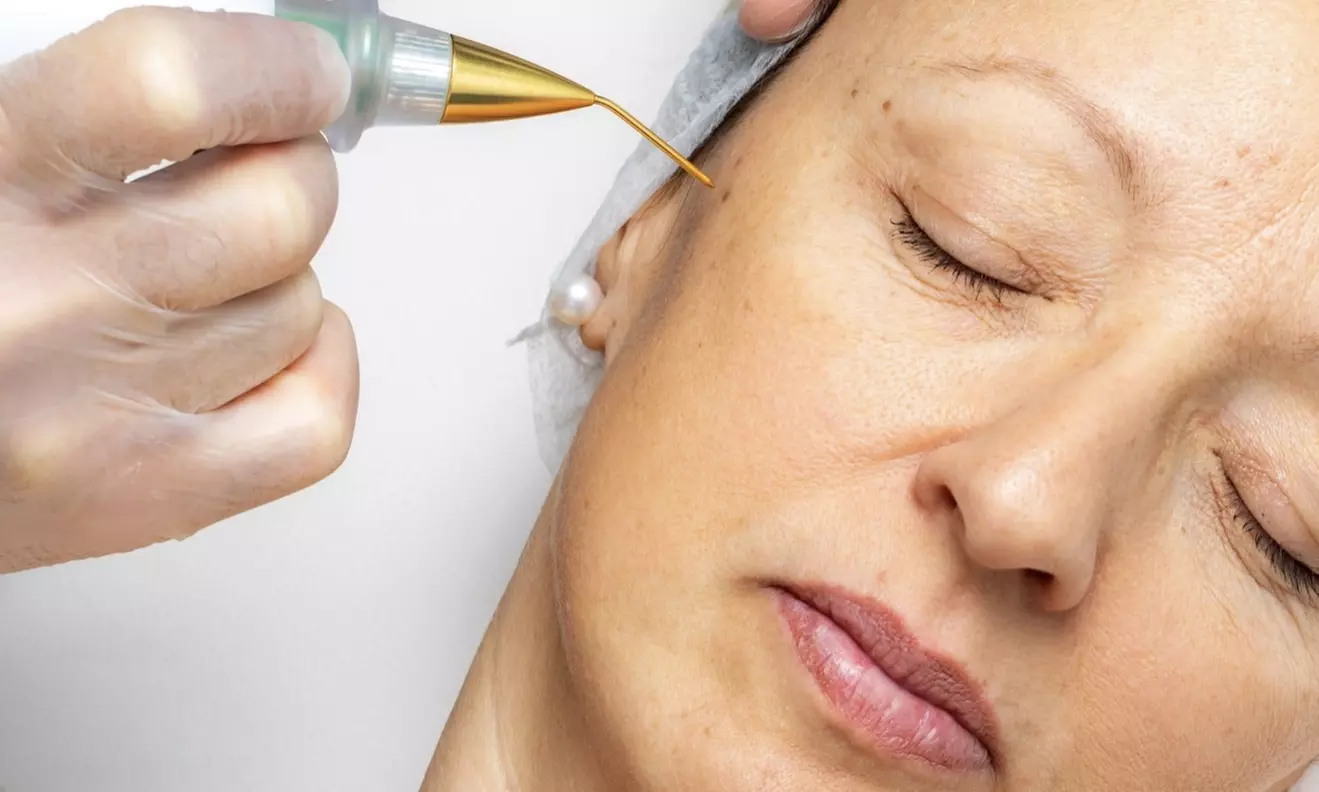 DOT Plasma For Wrinkles: Crows Feet, Forehead, Around the Mouth!