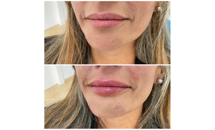 Image 2: ¡Infiltración de relleno dérmico con opción a blanqueamiento dental!