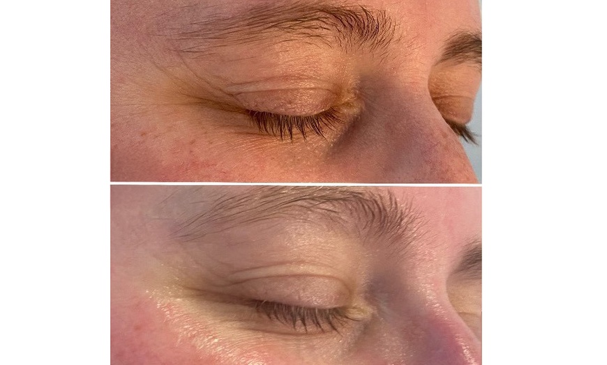 Image 2: Microneedling-Behandlung oder Enzym-Lifting-Paket für 1 Person