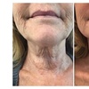 Image 3: HIFU Facial Treatments: Foxy Eyes, Double Chin, Neck & Lower Face
