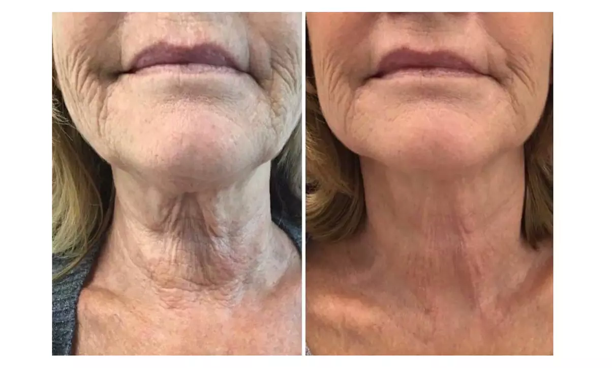 HIFU Facial Treatments: Foxy Eyes, Double Chin, Neck & Lower Face