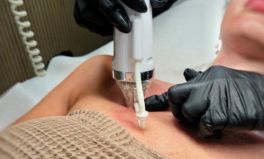 Image 1: Limpieza facial con peeling, cavitación, ampolla y mascarilla de algas 