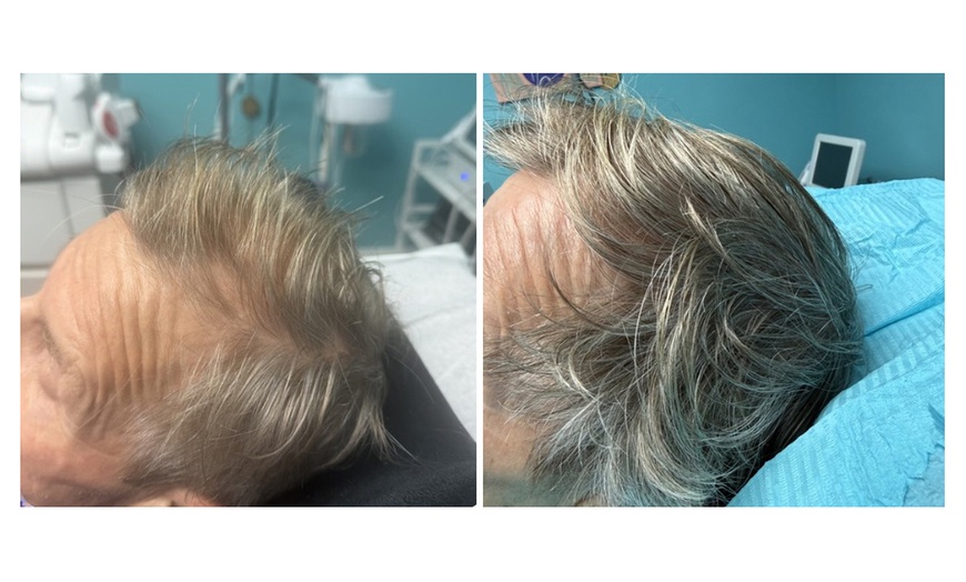 Image 7: Up to 54% Off on Hair Restoration - Non-Surgical at Aesthetics Care Med Spa