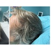 Image 7: Up to 54% Off on Hair Restoration - Non-Surgical at Aesthetics Care Med Spa
