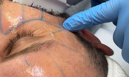 Tratamiento HIFU efecto rejuvenecimiento facial en rostro completo - Tellamor Clinic