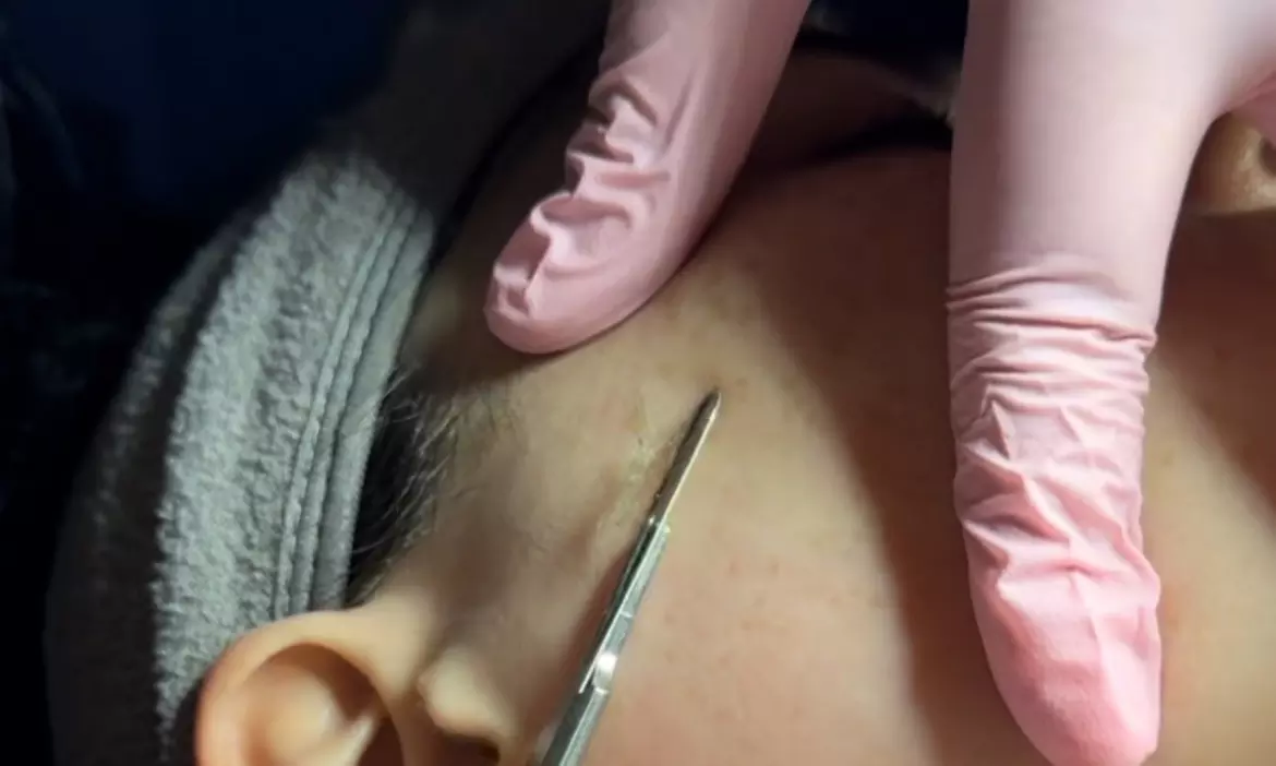 Deep Cleansing & Deep Pore Facials + Extractions, Enzyme & LED Therapy