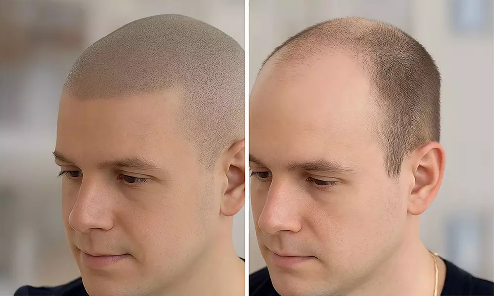 Haarpigmentierung, Narbenkorrektur oder Kurzhaarschnitt für 1 Person