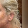 Image 1: Up to 35% Off on Facelift - Thread Lift at Amy Speer PAC at Rejuvenation Wellness
