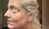 Up to 35% Off on Facelift - Thread Lift at Amy Speer PAC at Rejuvenation Wellness