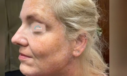 PDO threads for lip border definition - Amy Speer PAC at Rejuvenation Wellness