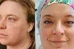 Transform With Laser Resurfacing Or Morpheus Microneedling With PRP Up to 45% Off at Apex Urology & Aesthetics - Second Medium