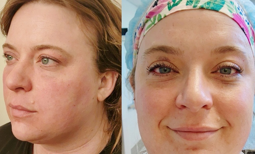 Image 2: Transform With Laser Resurfacing Or Morpheus Microneedling With PRP