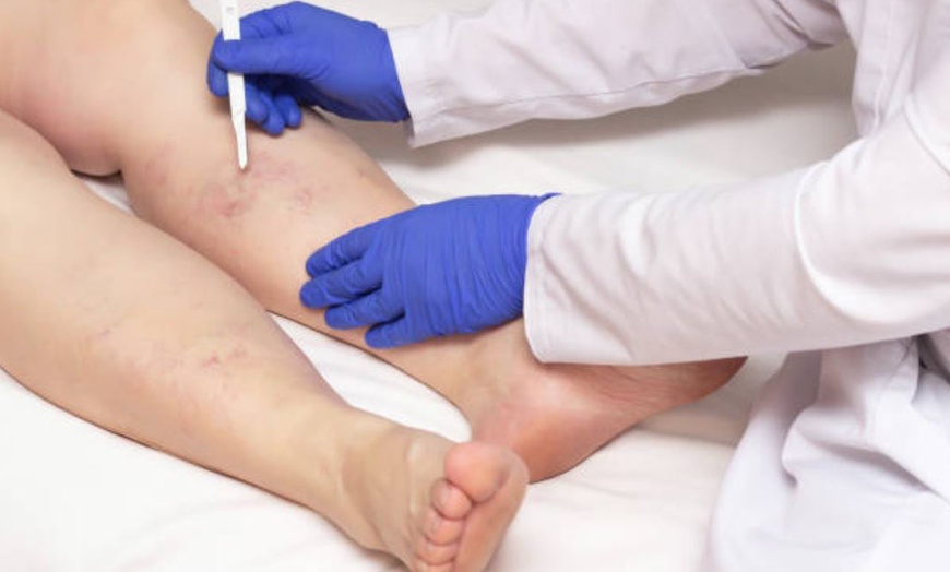 Image 3: Eliminación de varices o verrugas con tecnología avanzada 