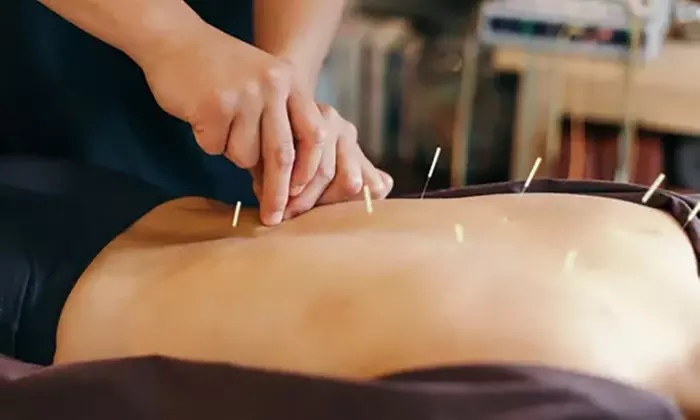 Up to 52% Off on Acupuncture at H Acupuncture