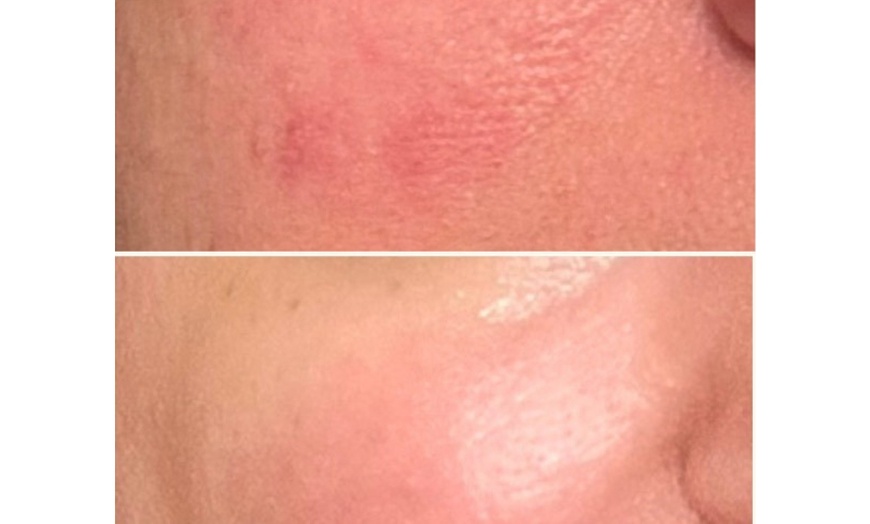Image 3: Revitalize with One or Three Polynucleotide HA Microneedling Treatment