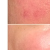 Image 3: Revitalize with One or Three Polynucleotide HA Microneedling Treatment