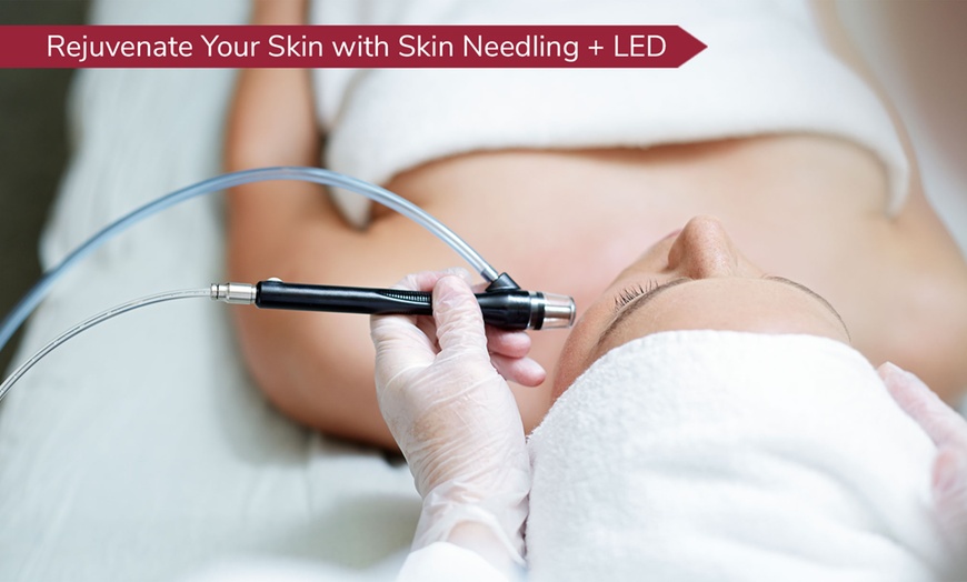Image 1: Rejuvenate Your Skin: Skin Needling with LED for Full Face & Neck