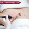 Image 1: Rejuvenate Your Skin: Skin Needling with LED for Full Face & Neck