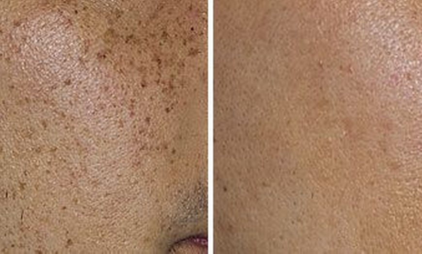 Image 3: Laser Dark Spot Removal Options for One Spot or 1, 3, or 6 Full Face