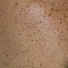 Image 3: Laser Dark Spot Removal Options for One Spot or 1, 3, or 6 Full Face