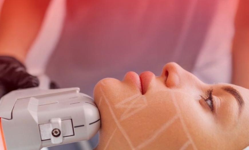 Image 2: 14D HIFU on Full Face, Neck, Declotage, or Jawline Contouring at Advanced Dermal Institute (Up to 51% Off)