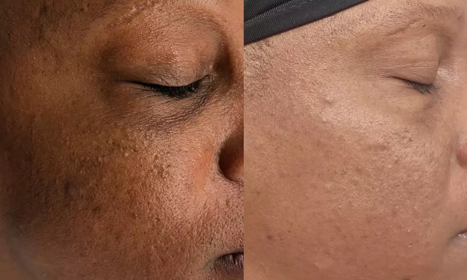 Transform Your Skin w/ One, Three, or Six 60-Min IPL Facial Sessions