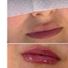 Image 6: Transform Smile: 0.5-, 1-, or 2-ml Dermal Filler or Dissolver & Refill