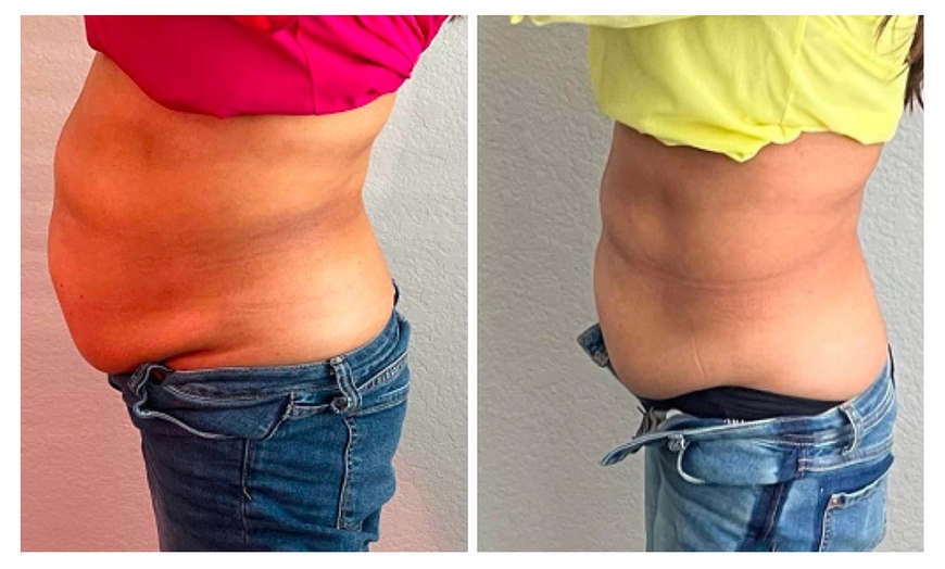 Image 3: RF Skin Tightening & Ultrasonic Cavitation