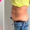 Image 3: RF Skin Tightening & Ultrasonic Cavitation
