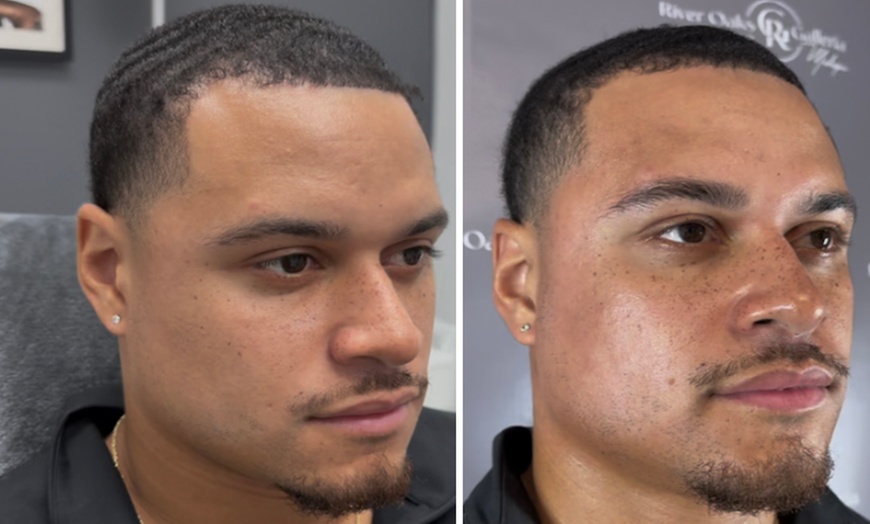 Image 4: Reveal Glowing Skin with One or Two VI Peel